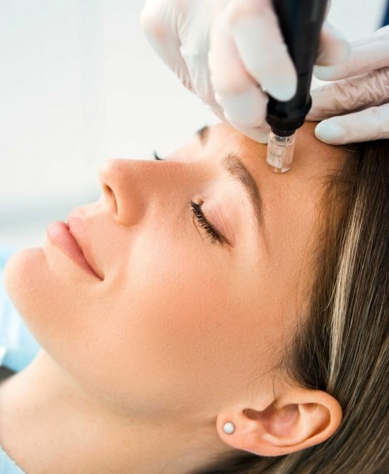 Dermapen skin needling